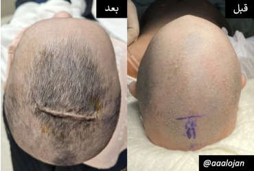 جراحة المناظير لتجميل الجمجمه