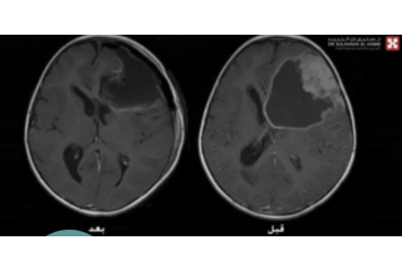 جراحة أورام الدماغ والحبل الشوكي لدى الأطفال