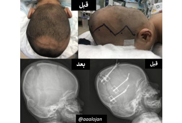 جراحه تجميل الجمجمة (الدروز اللامبدي Lambdoid Synostosis)